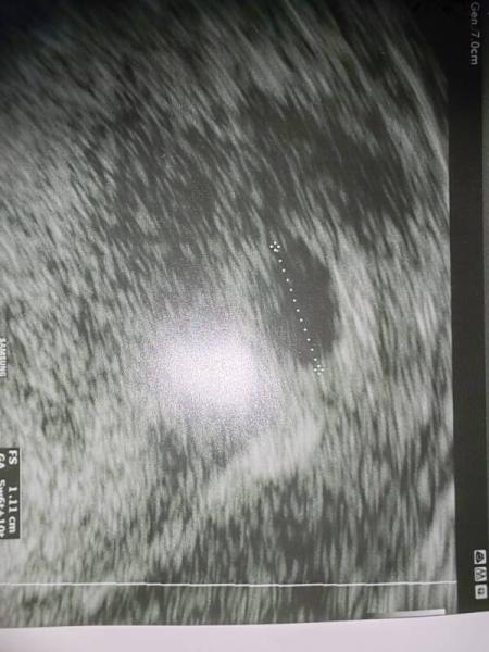 Bild zu Ssw6+2 - Schwanger - wer noch? Rund um die Schwangerschaft