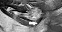 Bild zu Geschlecht schon erkennbar? SSW13 - Schwanger - wer noch? Rund um die Schwangerschaft