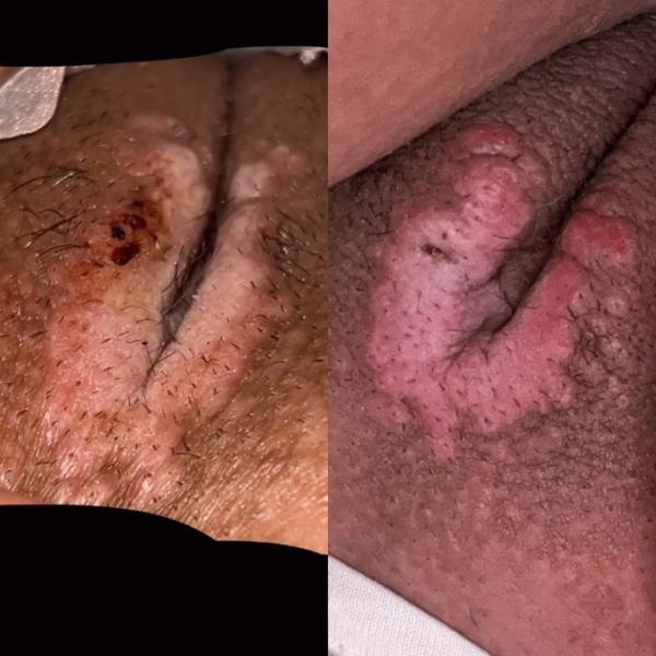 Bild zu Infektion schamlippen 37+2 - Schwanger - wer noch? Rund um die Schwangerschaft