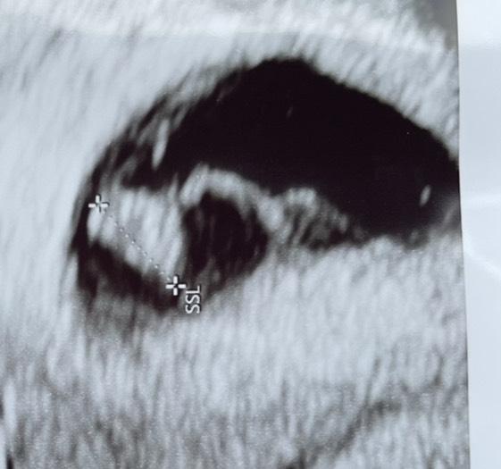 Bild zu Embryo nur 5mm in ssw 9?? - Schwanger - wer noch? Rund um die Schwangerschaft