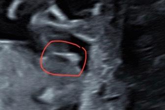 Bild zu Erkennt man das Geschlecht schon in SSW 13+0 - Schwanger - wer noch? Rund um die Schwangerschaft