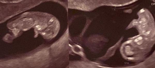 Bild zu Ultraschall Experten! Wer kann einwenig das Geschlecht erkennen? - Schwanger - wer noch? Rund um die Schwangerschaft