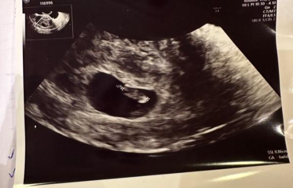 Bild zu Ramzi Theorie - Geschlecht vom Baby raten :) - Schwanger - wer noch? Rund um die Schwangerschaft
