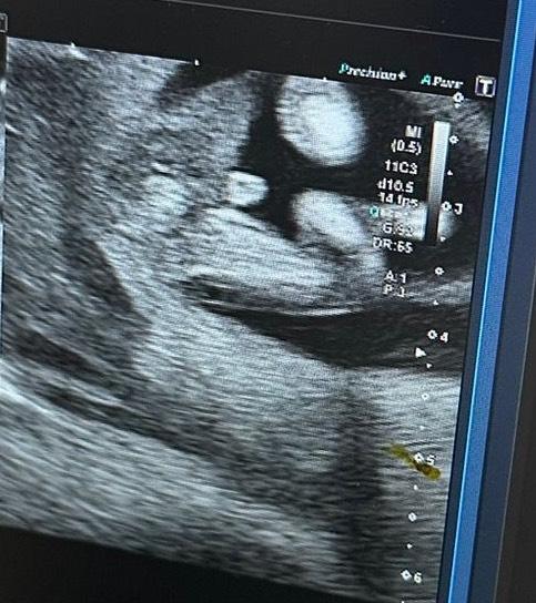 Bild zu Mädchen oder Junge? - Schwanger - wer noch? Rund um die Schwangerschaft