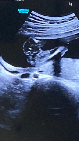 Bild zu Mädchen oder Junge, was meint ihr? - Schwanger - wer noch? Rund um die Schwangerschaft