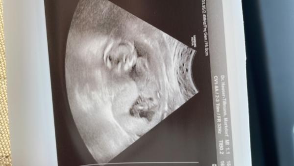 Bild zu 17.ssw baby sieht eingeengt aus - Schwanger - wer noch? Rund um die Schwangerschaft