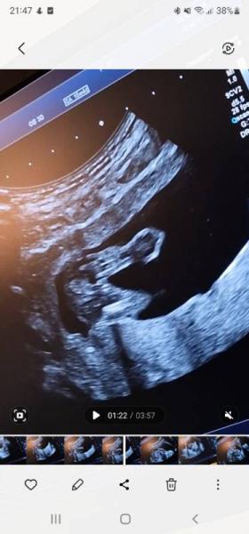 Bild zu Geschlecht 16ssw - Schwanger - wer noch? Rund um die Schwangerschaft