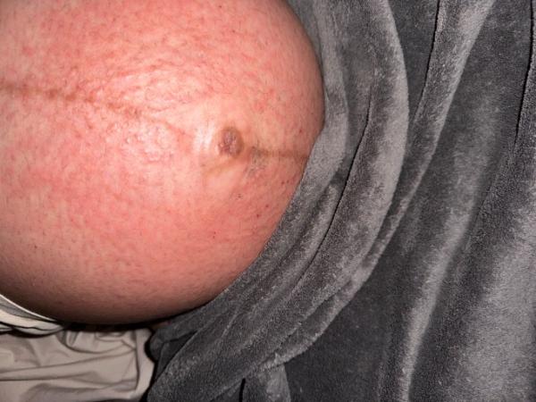 Bild zu Schlimmer Hautausschlag - Schwanger - wer noch? Rund um die Schwangerschaft