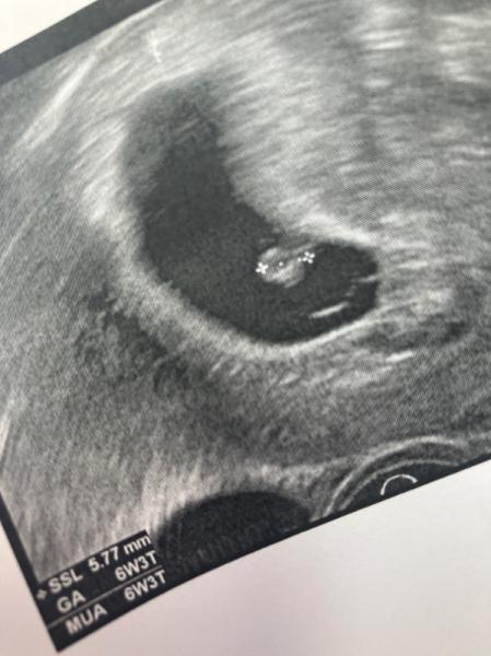 Bild zu 8SSW kleiner Embryo kein Herzschlag - Schwanger - wer noch? Rund um die Schwangerschaft