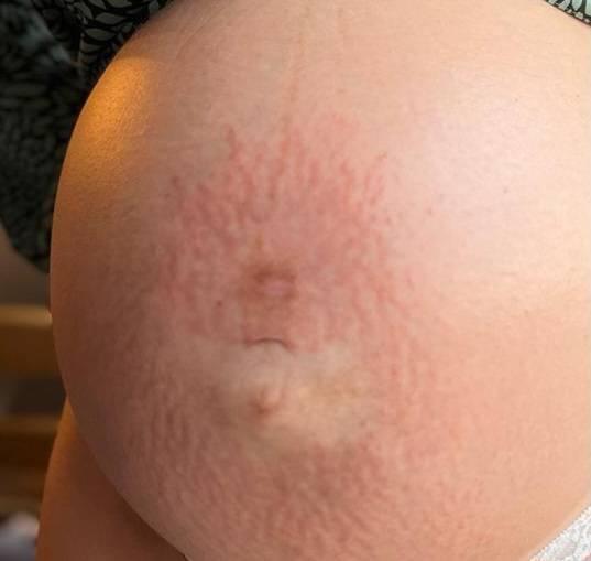 Bild zu Schwangerschaftsstreifen und Juckreiz - Schwanger - wer noch? Rund um die Schwangerschaft