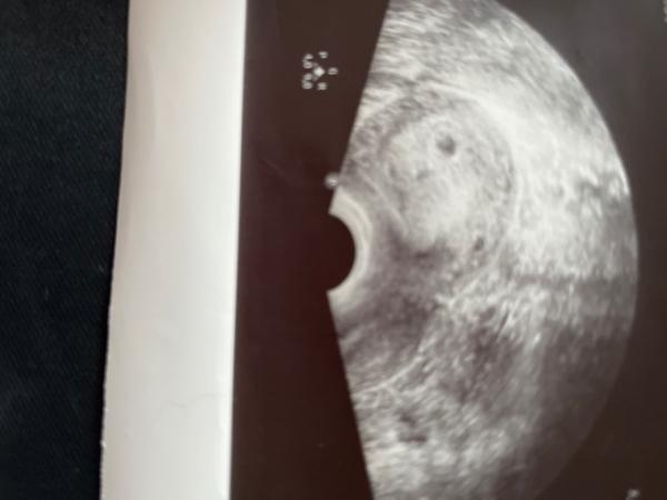 Bild zu Ultraschallbild von 5+1 - Schwanger - wer noch? Rund um die Schwangerschaft