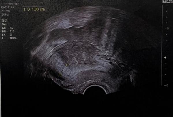 Bild zu Keine Fruchthöhle, nur aufgebaute Schleimhaut SSW 4+6 - Schwanger - wer noch? Rund um die Schwangerschaft
