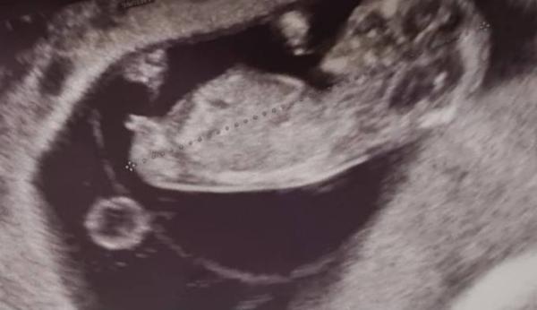 Bild zu Nub Theorie ssw11+2 - Schwanger - wer noch? Rund um die Schwangerschaft