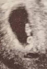 Bild zu Zwillinge ? 7+5 Was denkt ihr ? - Schwanger - wer noch? Rund um die Schwangerschaft