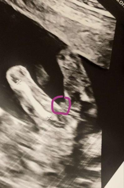Bild zu Mädchen oder Junge? - Schwanger - wer noch? Rund um die Schwangerschaft
