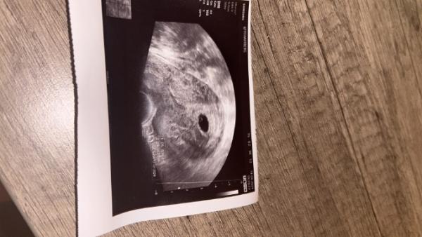 Bild zu Unsicher ob Embryo zu sehen ist - Schwanger - wer noch? Rund um die Schwangerschaft