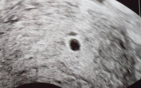 Bild zu Hoffnung? - Schwanger - wer noch? Rund um die Schwangerschaft