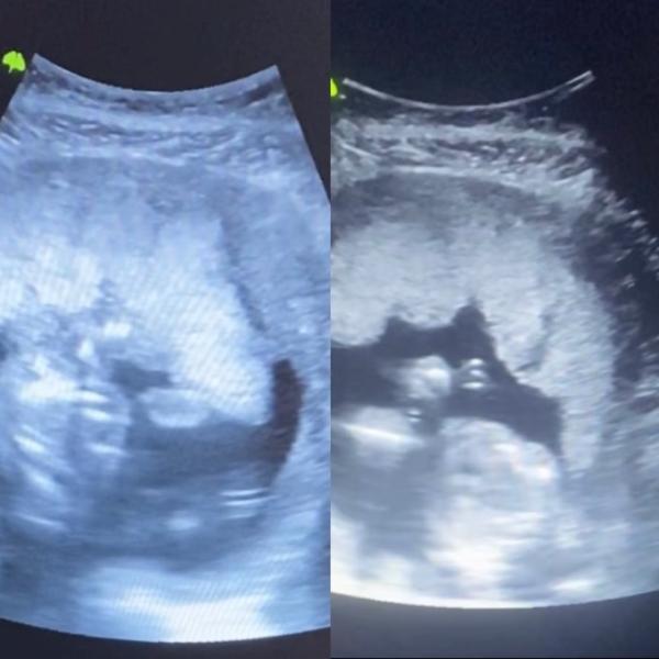 Bild zu Placenta Praevia marginalis - Schwanger - wer noch? Rund um die Schwangerschaft