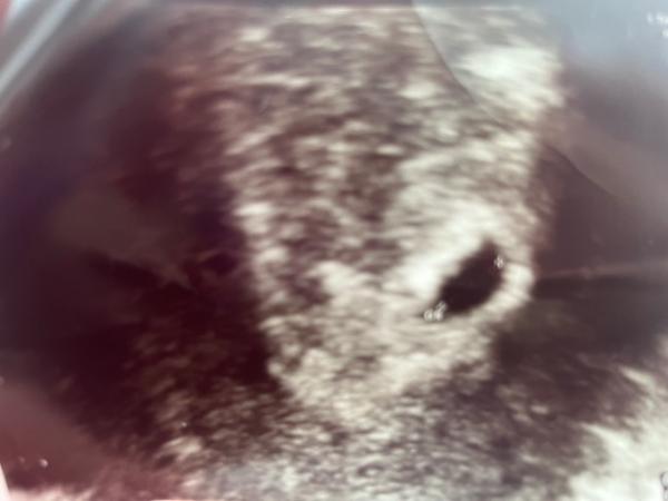 Bild zu Ist alles in Ordnung oder nicht sehe ein Punkt ist das des Baby ??? - Schwanger - wer noch? Rund um die Schwangerschaft