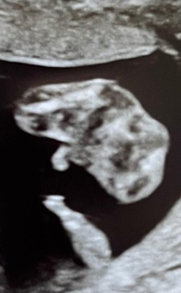 Bild zu Geschlechtsouting 16. ssw…wie sicher? - Schwanger - wer noch? Rund um die Schwangerschaft