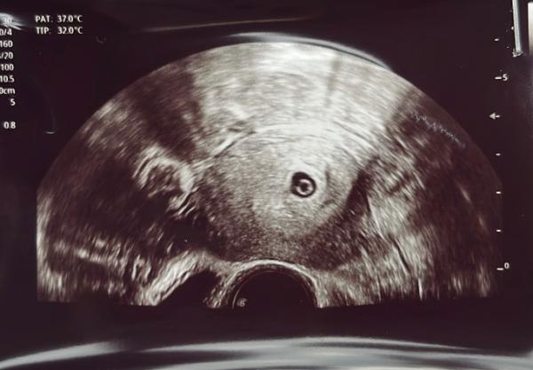 Bild zu 7+1 kein Embryo - Schwanger - wer noch? Rund um die Schwangerschaft