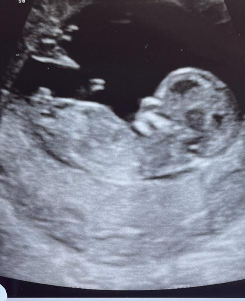 Bild zu Pränataldiagnostik 💙💗 - Schwanger - wer noch? Rund um die Schwangerschaft