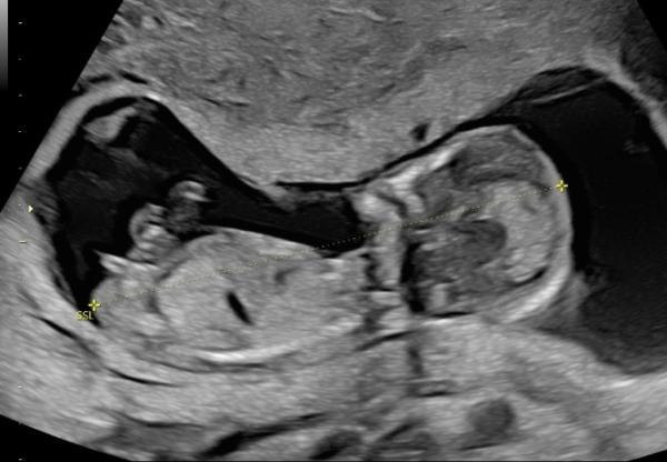 Bild zu Junge oder Mädchen? - Schwanger - wer noch? Rund um die Schwangerschaft