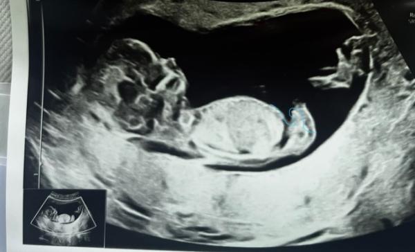 Bild zu It‘s a Boy 💙? - Schwanger - wer noch? Rund um die Schwangerschaft