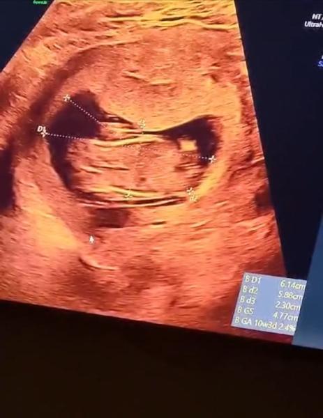 Bild zu 13+2 fruchtblase zu klein ? Mit Bild - Schwanger - wer noch? Rund um die Schwangerschaft