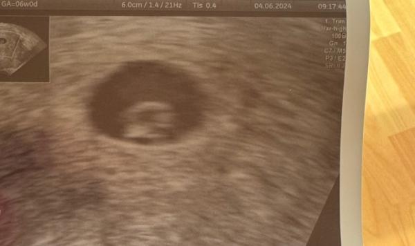 Bild zu Ultraschall - Schwanger - wer noch? Rund um die Schwangerschaft