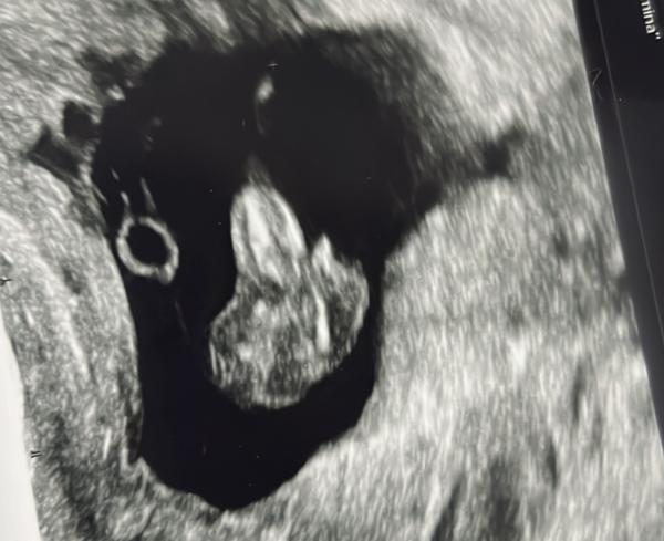 Bild zu Mädchen oder Junge? - Schwanger - wer noch? Rund um die Schwangerschaft