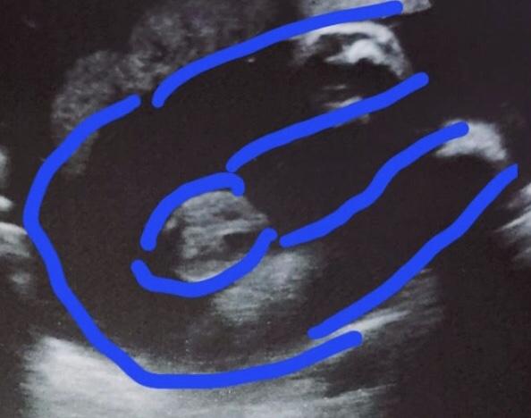 Bild zu 32 SSW, kein sicheres Geschlechtouting - Schwanger - wer noch? Rund um die Schwangerschaft