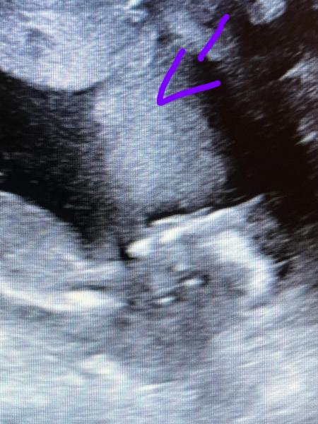 Bild zu Baby liegt mit Kopf tief unten versteckt - Schwanger - wer noch? Rund um die Schwangerschaft