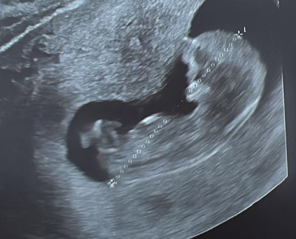 Bild zu Mädchen oder Junge? - Schwanger - wer noch? Rund um die Schwangerschaft