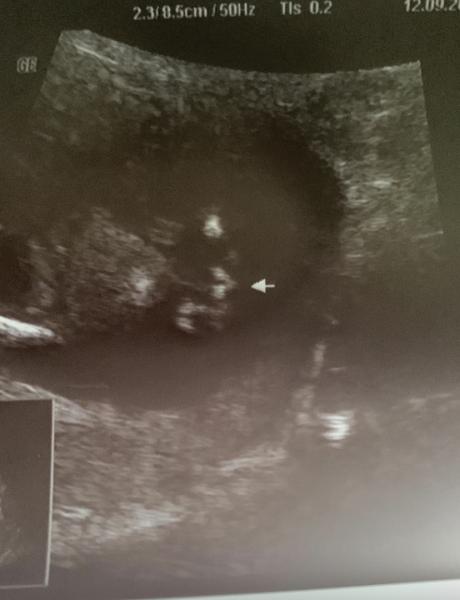 Bild zu Ultraschall Bild - Schwanger - wer noch? Rund um die Schwangerschaft
