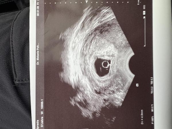 Bild zu Windei oder versteckter Embryo - Schwanger - wer noch? Rund um die Schwangerschaft