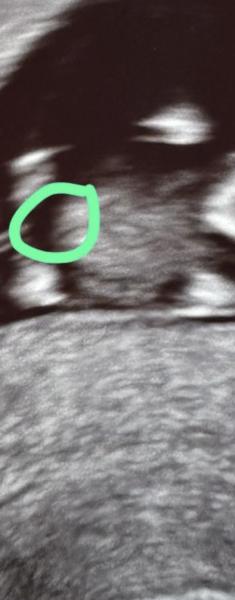 Bild zu Geschlecht erkennbar? - Schwanger - wer noch? Rund um die Schwangerschaft