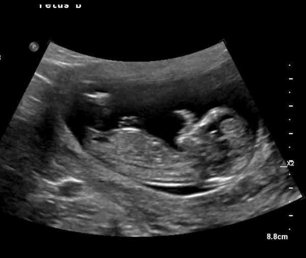 Bild zu Hat die Nub Theory bei euch gestimmt ?🤰🏻 - Schwanger - wer noch? Rund um die Schwangerschaft