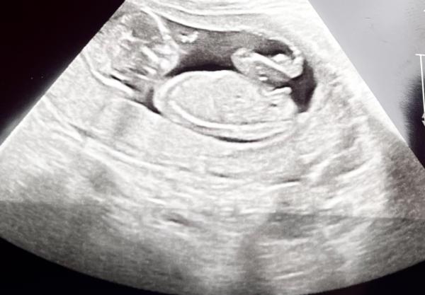 Bild zu Hat die Nub Theory bei euch gestimmt ?🤰🏻 - Schwanger - wer noch? Rund um die Schwangerschaft