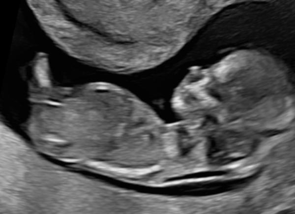 Bild zu Nub-Theorie - Wahrheit oder Mythos? - Schwanger - wer noch? Rund um die Schwangerschaft