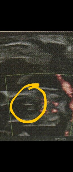 Bild zu 14 SSW - Junge oder Mädchen? - Schwanger - wer noch? Rund um die Schwangerschaft