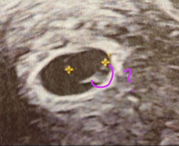Bild zu Wie (von wo bis wo) wird Embryo vermessen Frühschwangerschaft - Schwanger - wer noch? Rund um die Schwangerschaft