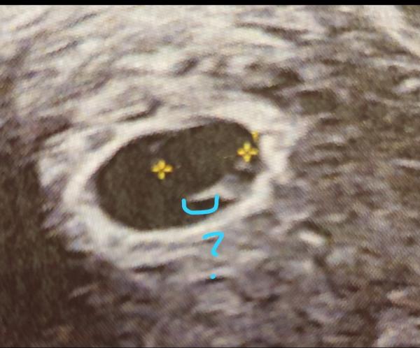 Bild zu Wie (von wo bis wo) wird Embryo vermessen Frühschwangerschaft - Schwanger - wer noch? Rund um die Schwangerschaft