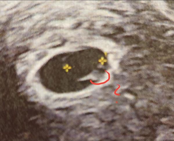 Bild zu Wie (von wo bis wo) wird Embryo vermessen Frühschwangerschaft - Schwanger - wer noch? Rund um die Schwangerschaft