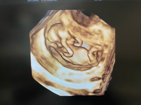 Bild zu Mädchen oder junge - Schwanger - wer noch? Rund um die Schwangerschaft