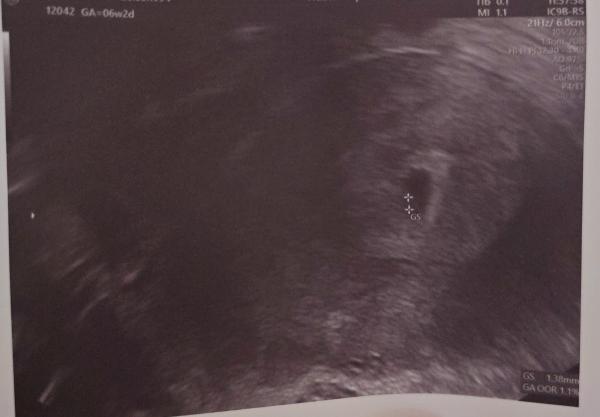 Bild zu SSW 6+3 , kein Embryo aber Dottersack zusehen - Schwanger - wer noch? Rund um die Schwangerschaft