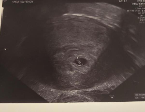 Bild zu SSW 6+3 , kein Embryo aber Dottersack zusehen - Schwanger - wer noch? Rund um die Schwangerschaft