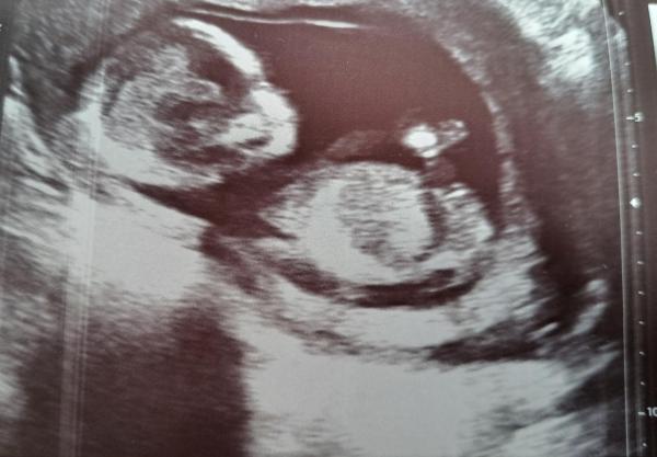 Bild zu NUB erkennbar? Girl or Boy?🩷🩵 - Schwanger - wer noch? Rund um die Schwangerschaft