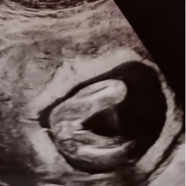 Bild zu Mädchen oder junge? - Schwanger - wer noch? Rund um die Schwangerschaft