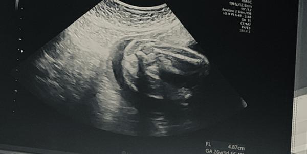 Bild zu Mädchen oder Junge 26 ssw - Schwanger - wer noch? Rund um die Schwangerschaft